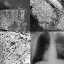 آزبست، Asbesto